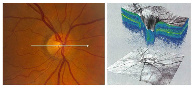 Tomographie par cohérence optique