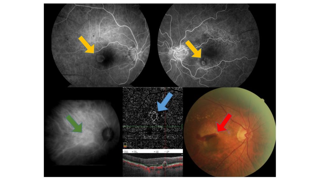 • Néovaisseaux visibles (type 2) mis en évidence lors d’une angiographie en fluorescéine - avec injection intra-veineuse de produit de contraste (flèche orange) , • Néovaisseaux occultes (type 1) mis en évidence lors d’une angiographie au vert d’indocyanine -avec injection intra-veineuse de produit de contraste (flèche verte), • Néovaisseaux occultes en OCT-Angiographie - sans injection (flèche bleue) • DMLA hémorragique sur rétinophotographie(flèche rouge)