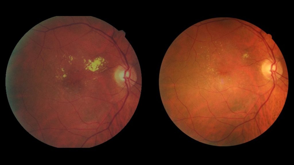 Avant et après laser focal. Disparition des exsudats.