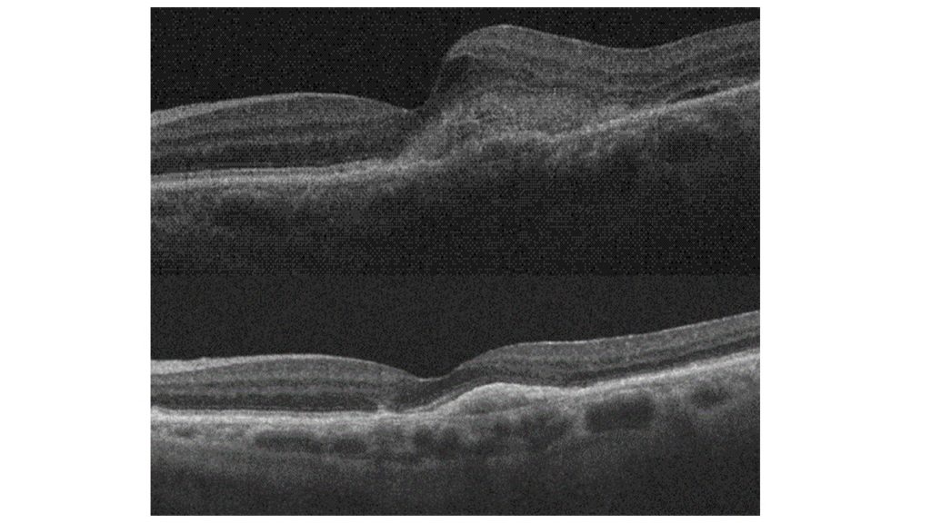 Le suivi thérapeutique de la DMLA exsudative se fait grâce à l’acuité visuelle, l’examen du fond d’œil et l’OCT. Image OCT avant Injection intra-vitréenne d’anti VEGF (en haut) et après IVT (en bas). La restauration partielle de l’anatomie et la stabilisation des lésions grâce aux IVT récurrentes permet la stabilisation de la vision centrale.