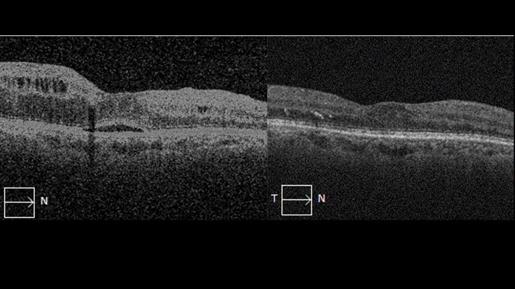 Avant et après injections intra vitréennes : Amélioration de l’acuité visuelle et du profil maculaire en OCT.