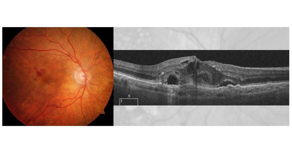 DMLA Exsudative (Humide) en rétinophotographie (à gauche) et sur OCT (à droite) : hémorragies maculaires, kystes intra rétiniens, liquide sous rétinien