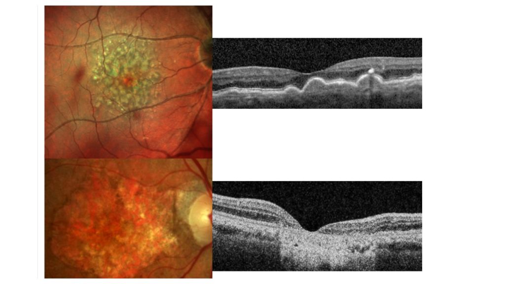 DMLA Sèche sur rétinophotographie (à gauche) et sur OCT (à droite) : Drusen, altérations de l’épithélium pigmentaire, atrophie maculaire