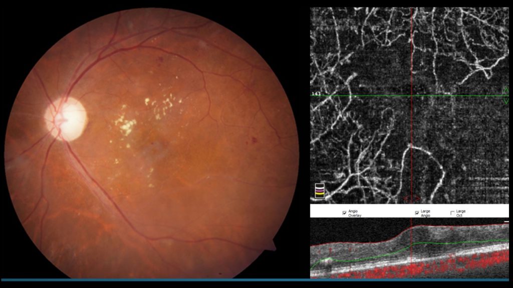 Maculopathie ischémique diabétique en OCT-Angiographie : Interruption de la vascularisation maculaire, baisse d’acuité visuelle irréversible