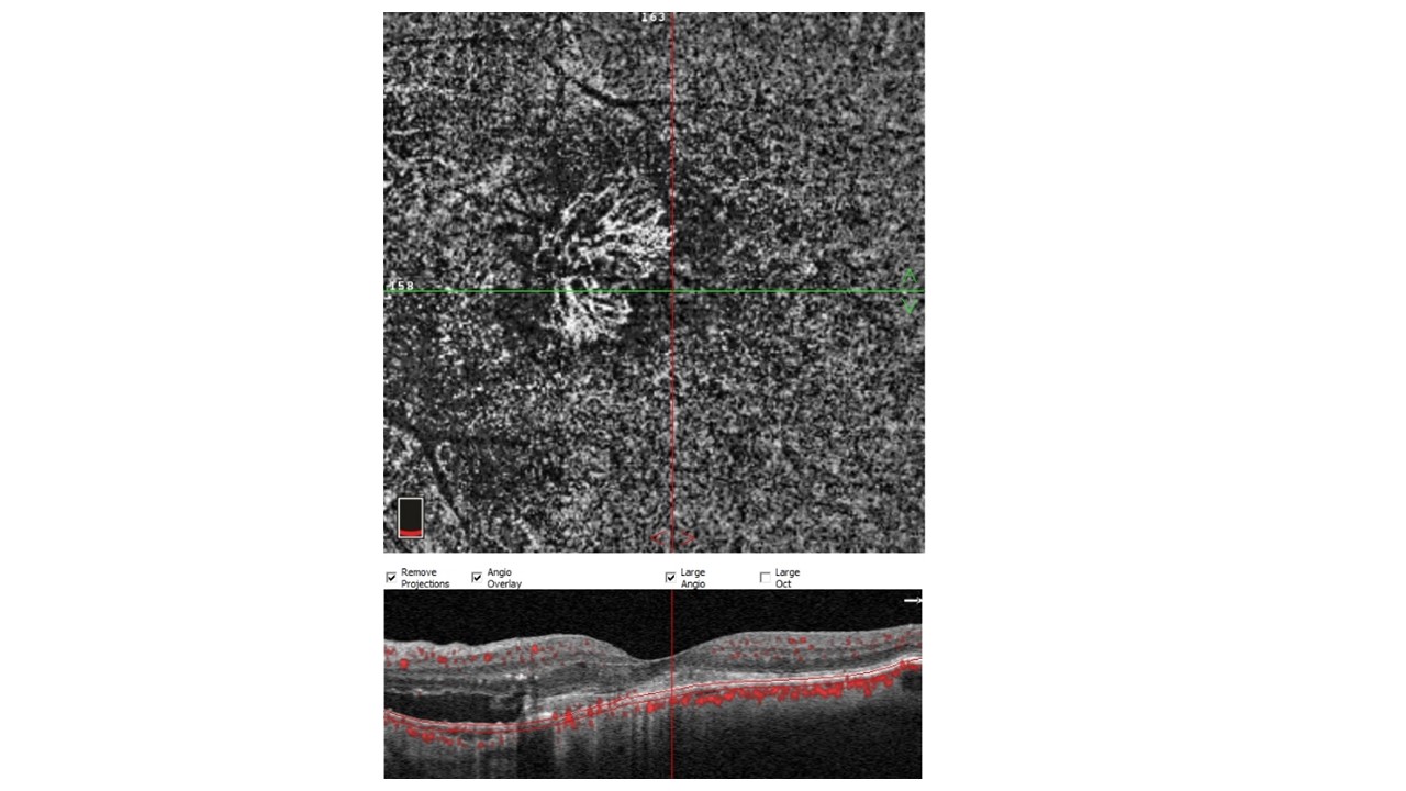 L’OCT-angiographie permet de détecter le néovaisseaux sans avoir besoin d’injecter un produit de contraste.