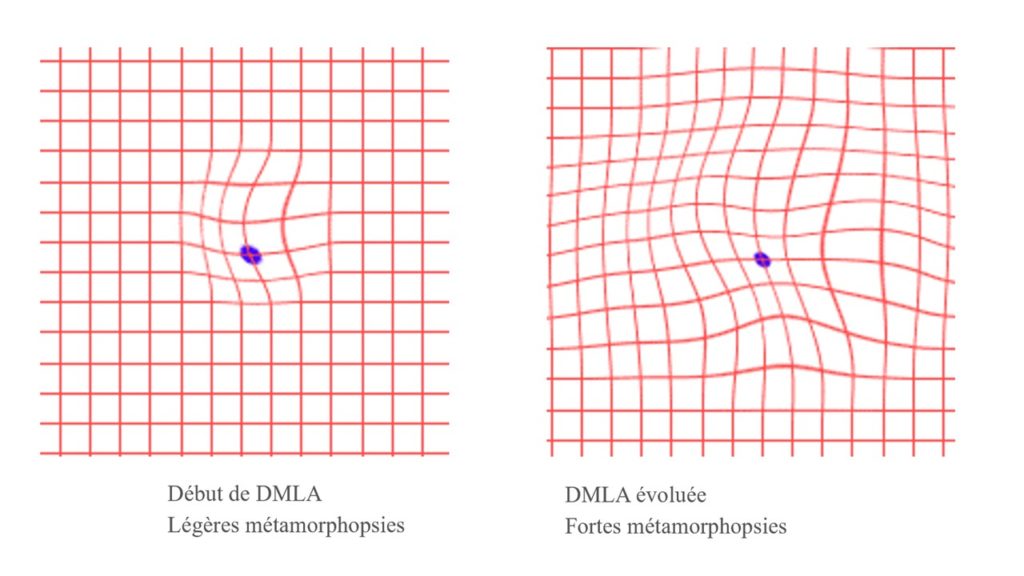 Surveillance des déformations (métamorphopsies) de la DMLA sur grille d’Amsler