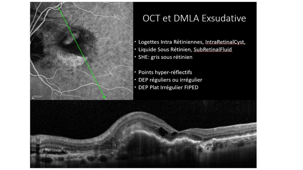 Les signes OCT de la DMLA Exsudative