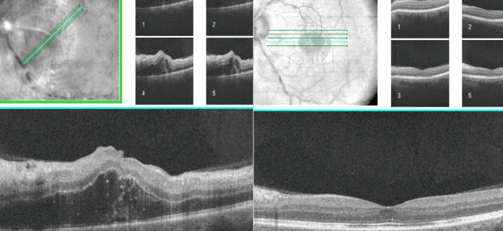 Examen OCT : Avant et après injections intra vitréennes : Nette amélioration de l’acuité visuelle et du profil maculaire