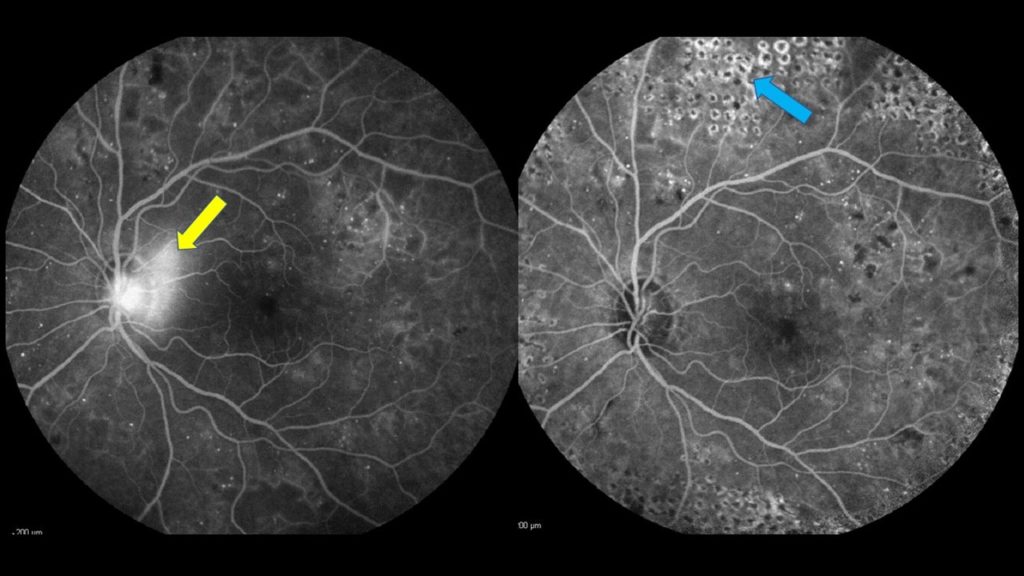 Rétinopathie proliférante en angiographie à la fluorescéine : Un néovaisseaux (flèche jaune) sur la papille optique menace la vue, celui se rétracte ou disparait lorsque la panphotocoagulation rétinienne laser est réalisée.